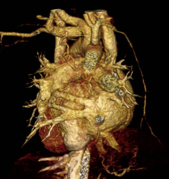 4 months old male infant with cyanosis, Systolic heart mummer in left intercostals' space